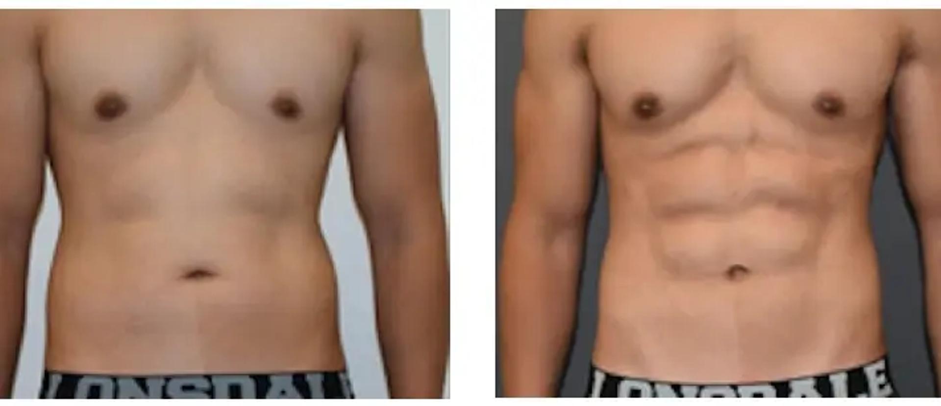 https://images.ctfassets.net/0sp2blbxv3p7/1AYSuiebDYPt0EGW9ldInW/b14baeb00ab02eda3e887a15200ed528/Vaser-Liposuction.webp