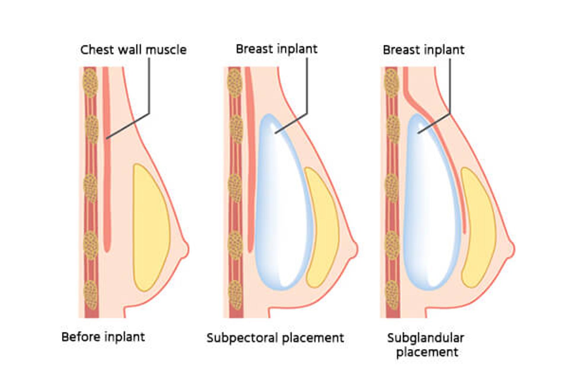 https://images.ctfassets.net/0sp2blbxv3p7/6A2lliZ4zyAJkI7A1Y1VmQ/8a56978afd898096bc9763bf853b2d8f/breast-augmentation.jpg